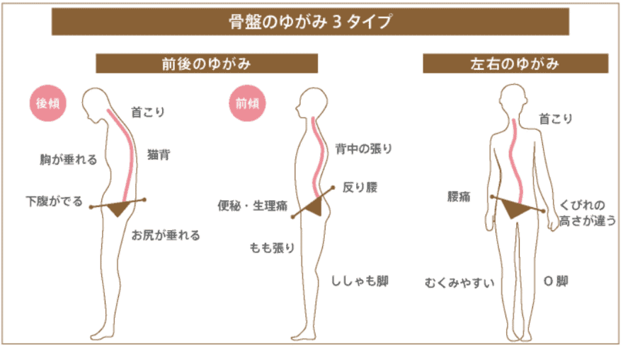 驚愕 福岡市の安いと有名なおすすめ骨盤矯正10選 骨盤矯正は産後の体型戻しやダイエットに効果的 なるほど福岡