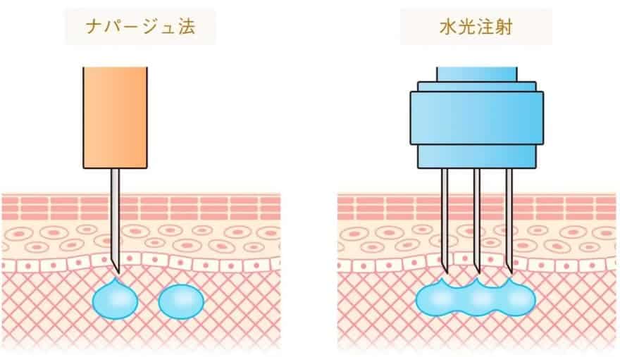 水光注射ナパージュ法とマシンの違い