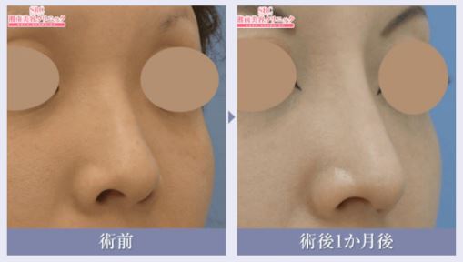 鼻整形ビフォーアフター