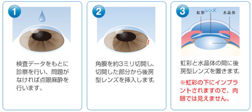 ICL治療の仕組み