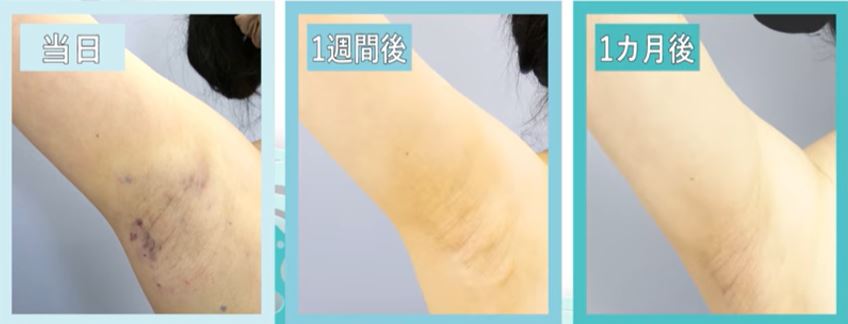 湘南美容クリニック ミラドライ