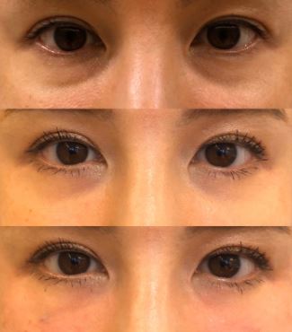 目の下の切らないたるみ取り(脱脂術)の経過写真