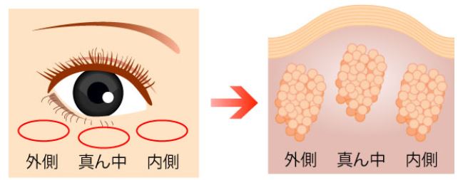 眼窩脂肪は3つの部位にある