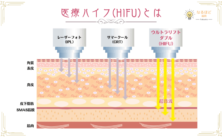 医療ハイフとほか施術の照射範囲を比較したイメージ画像