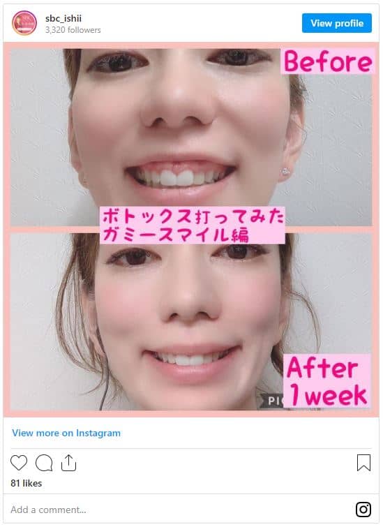 福岡でガミースマイルボトックスが安いおすすめクリニック7選 歯茎にボトックスは効かない 失敗例やデメリットを解き明かす なるほど福岡 福岡でガミースマイルボトックスが安いおすすめクリニック7選 歯茎にボトックスは効かない 失敗例やデメリットを解き明かす なるほど福岡