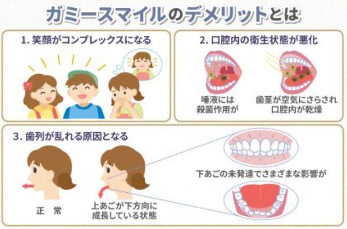 福岡でガミースマイルボトックスが安いおすすめクリニック7選 歯茎にボトックスは効かない 失敗例やデメリットを解き明かす なるほど福岡
