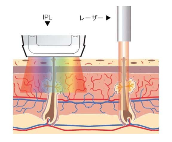 IPLとレーザー