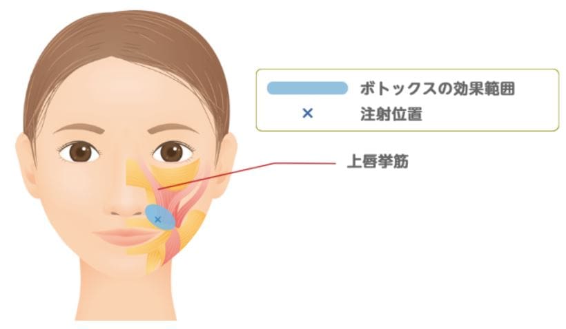 ガミースマイルボトックスを打つ場所