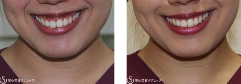 聖心美容クリニック症例写真