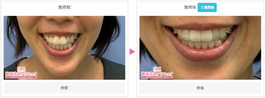 ガミーボトックス症例写真