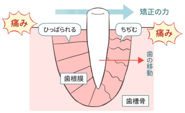 マウスピース矯正の痛み