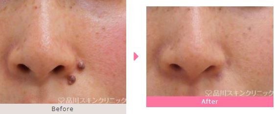 品川美容外科　ほくろ取り