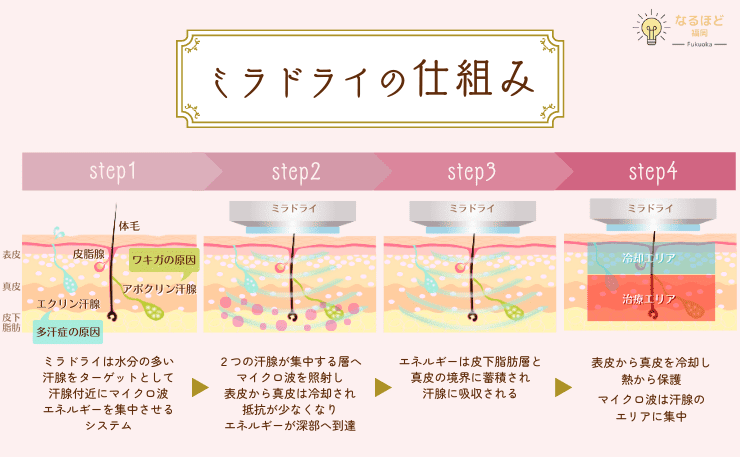 ミラドライの施術の仕組みを解説した画像