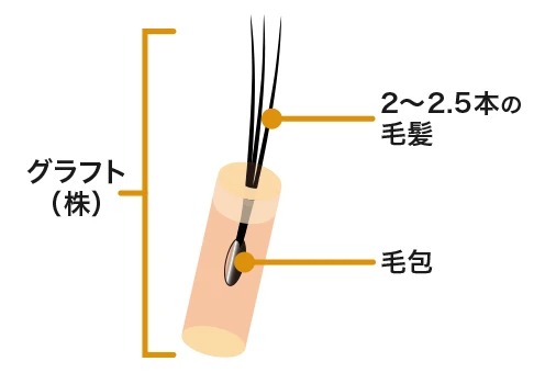 親和クリニック グラフト 説明図