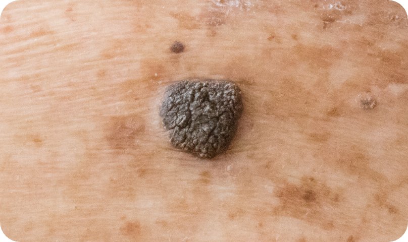 脂漏性角化症