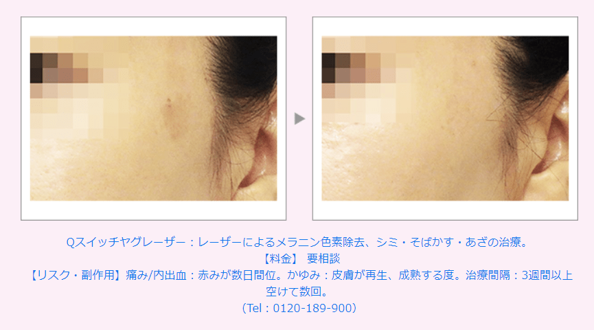 Qスイッチヤグ（YAG）レーザー　施術例