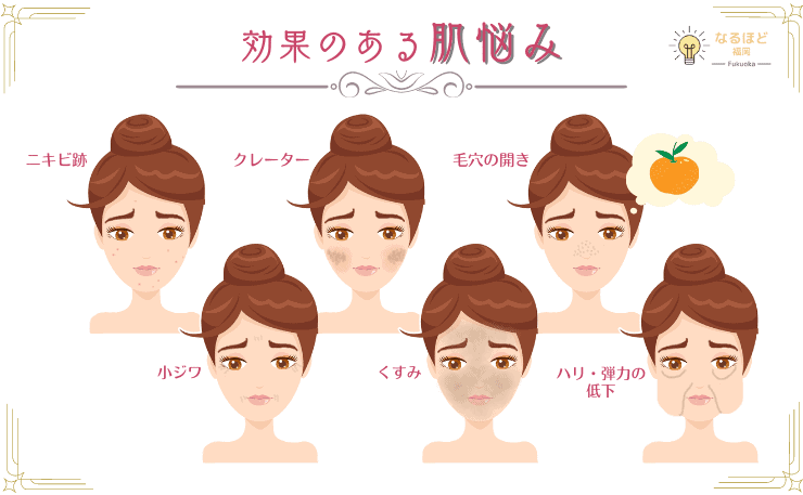 ダーマペン4が効果を発揮する肌悩みの事例を挙げたイメージ画像
