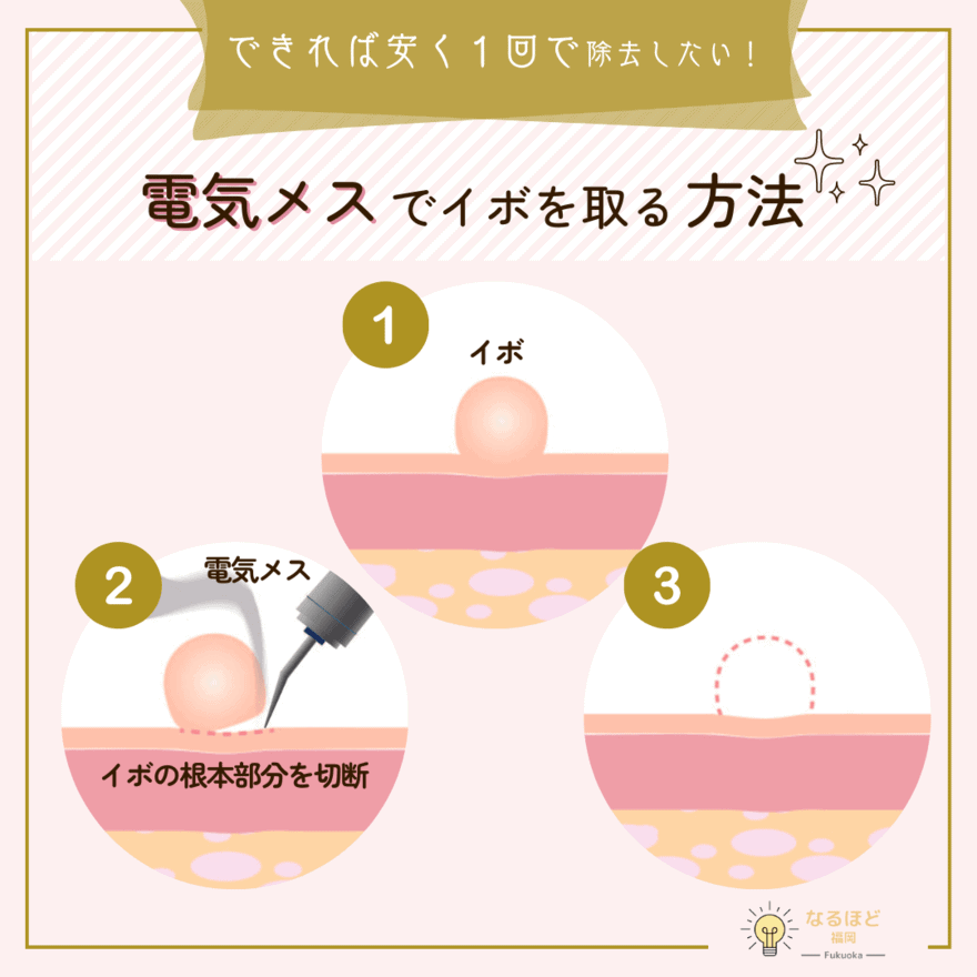 電気メスでイボを除去する際の工程のイメージ図