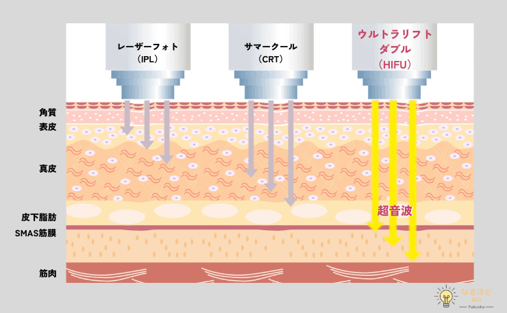 医療ハイフとほか施術の照射範囲を比較したイメージ画像