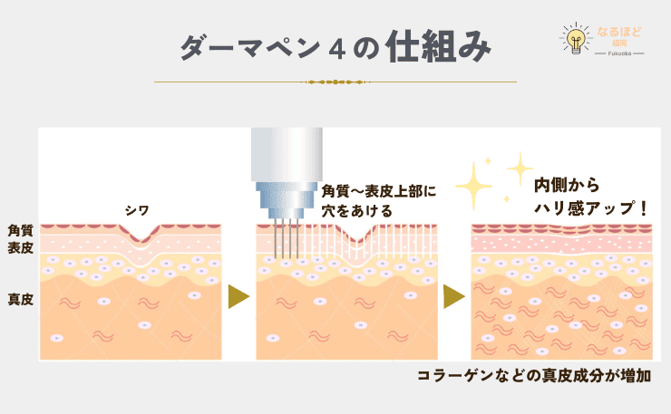 ダーマペン４の仕組みと効果を解説したイメージ画像