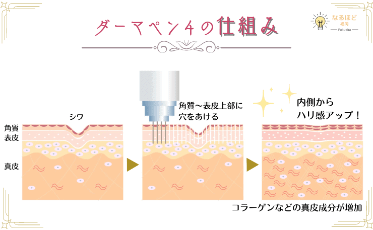 ダーマペン４の仕組みと効果を解説したイメージ画像