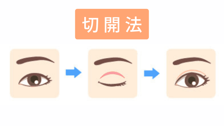 久留米のクリニックで受けられる切開法の解説画像