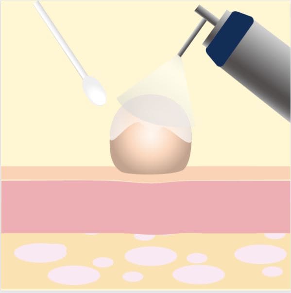 液体窒素でイボを除去する際のイメージ画像