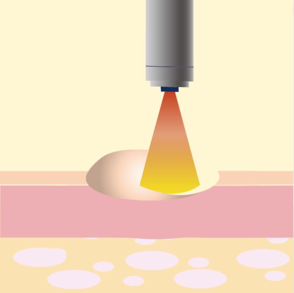 レーザーでイボを除去する際のイメージ画像