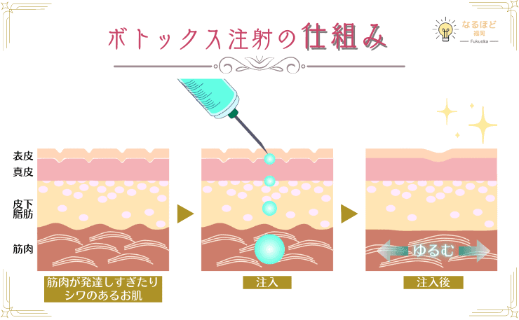 肩ボトックスを打つ回数