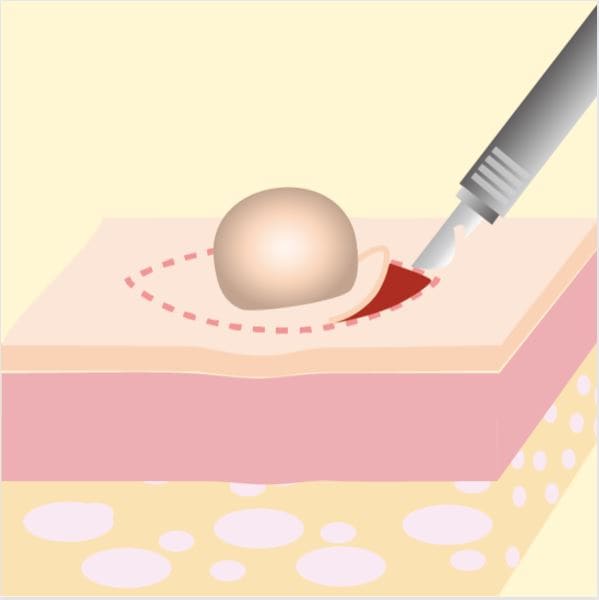 メスで切開してイボを除去する際のイメージ画像