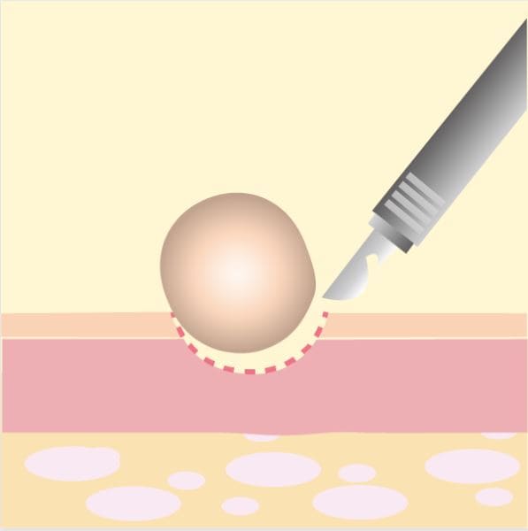 メスでくり抜いてイボを除去する際のイメージ画像