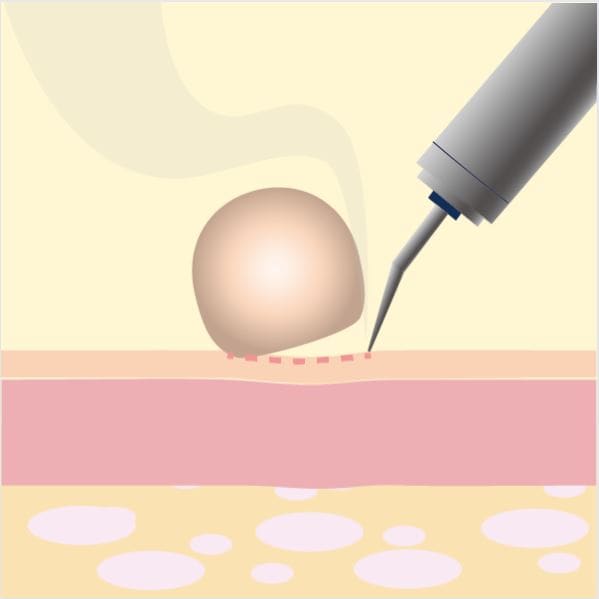 電気メスでイボを除去する際のイメージ画像