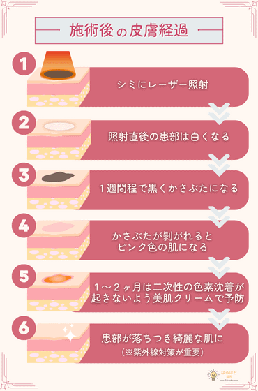 ピコスポット施術後の皮膚経過を解説した画像