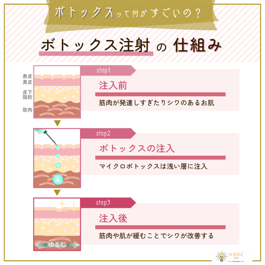 マイクロボトックスの仕組みを挙げたイメージ画像