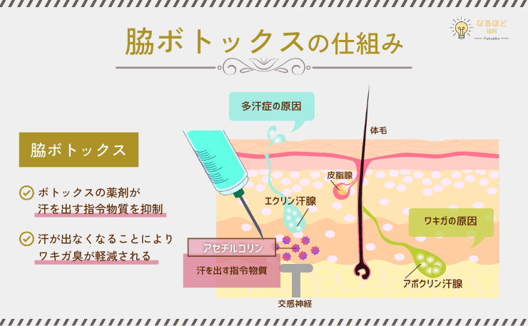 脇ボトックスの仕組みを解説したイメージ画像